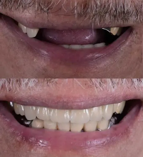 before and after smile 1