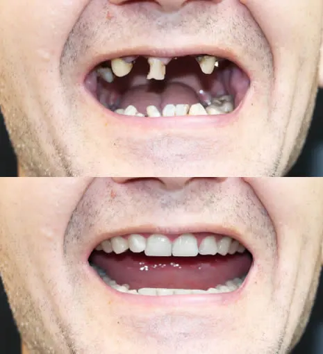 before and after smile 2