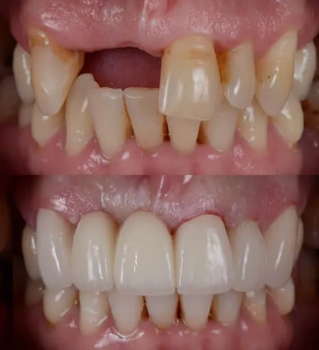 before and after smile 3