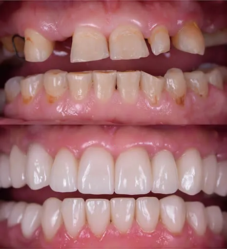 before and after smile 4