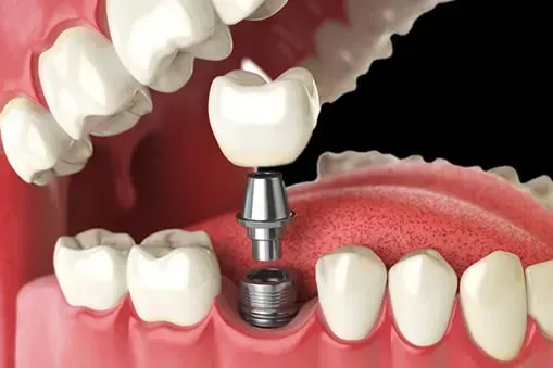 Single Dental Implants