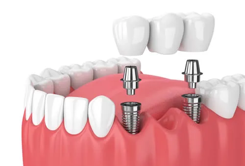 dental implant bridge